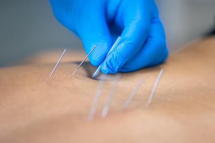 Receptores de Adenosina A1 medeiam os efeitos anti nociceptivos locais da acupuntura